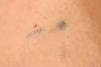 Trial 2_PI_Photo entity_Radiotherapy tattoo marks.