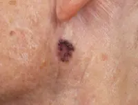 Photograph of pigmented basal cell cancer.