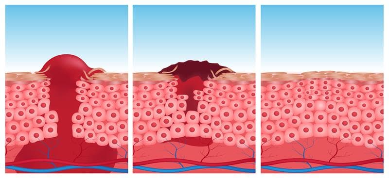 Image of wound healing.